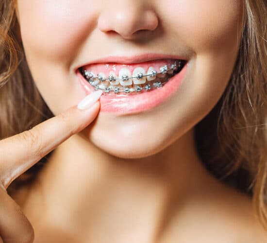 Metal braketlerle ortodonti tedavisi görmüş bir gülüş